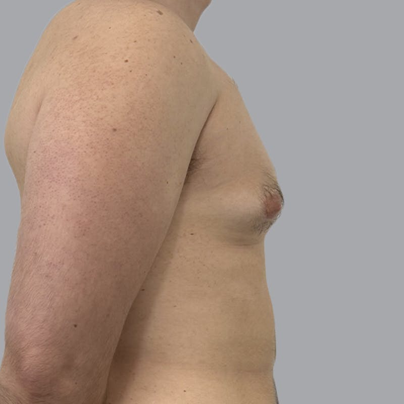 Gynecomastia Before & After Gallery - Patient 312178 - Image 5