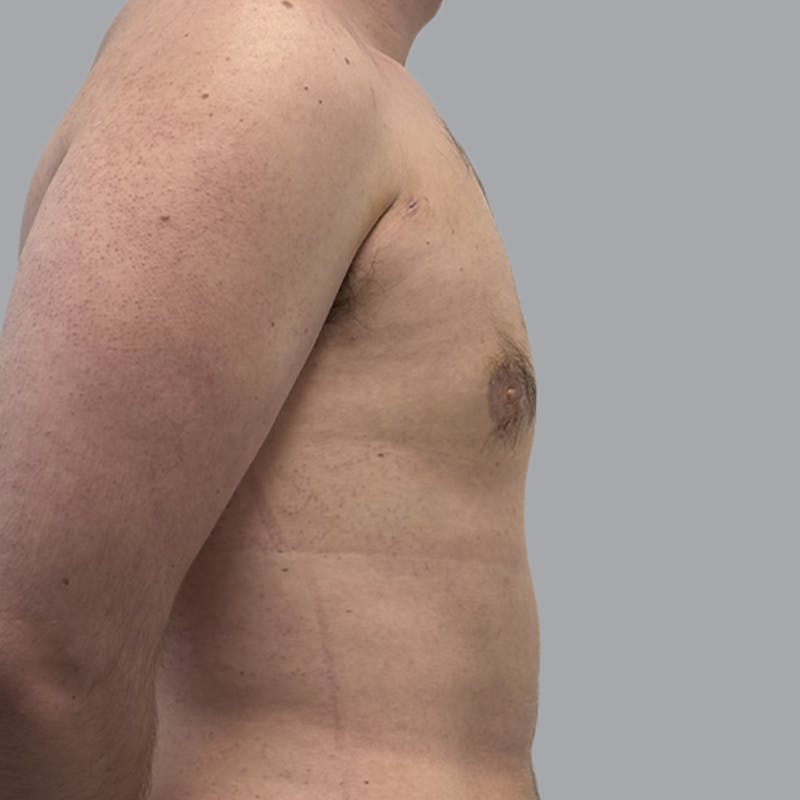 Gynecomastia Before & After Gallery - Patient 312178 - Image 6