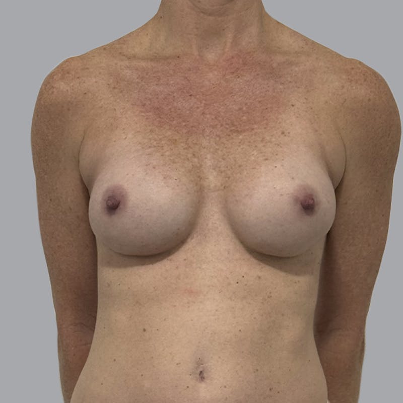 Breast Implant Removal Before & After Gallery - Patient 410868 - Image 1