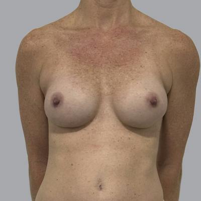Breast Implant Removal Before & After Gallery - Patient 410868 - Image 1