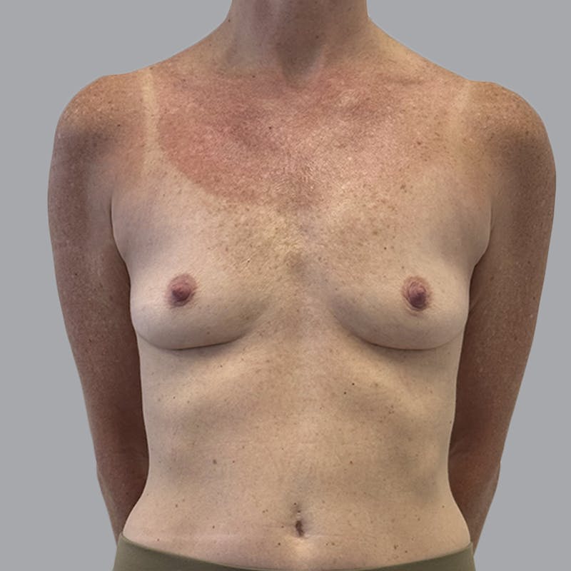 Breast Implant Removal Before & After Gallery - Patient 410868 - Image 2
