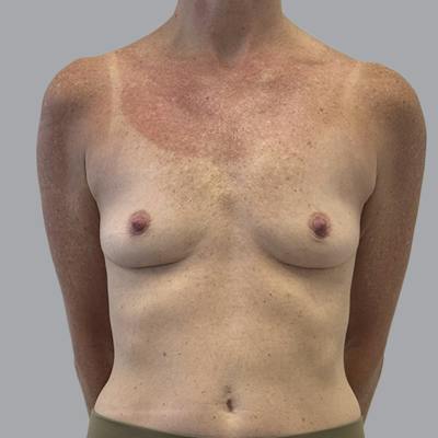 Breast Implant Removal Before & After Gallery - Patient 410868 - Image 2