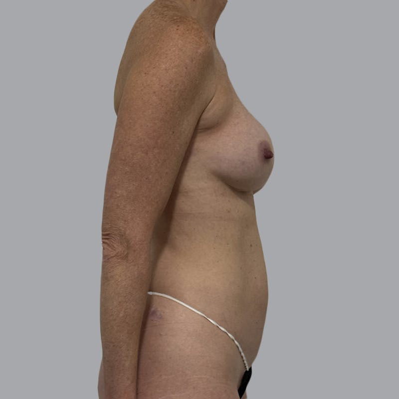 Breast Implant Removal Before & After Gallery - Patient 410868 - Image 5