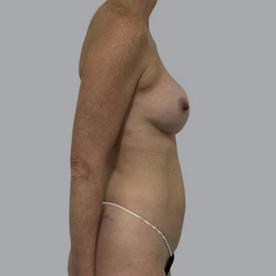 Breast Implant Removal Before & After Gallery - Patient 410868 - Image 5