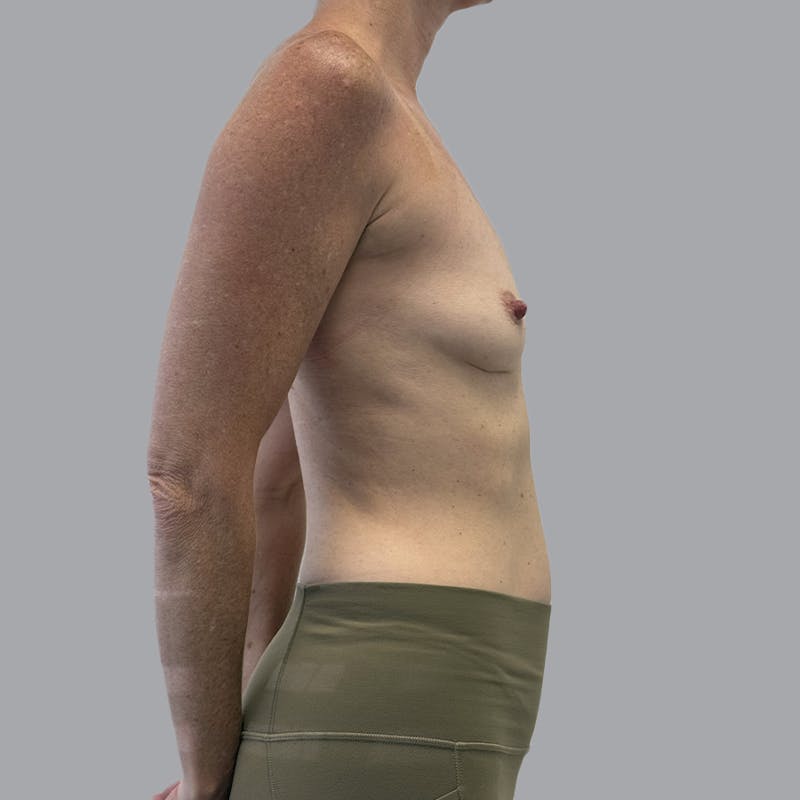 Breast Implant Removal Before & After Gallery - Patient 410868 - Image 6