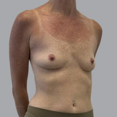 Breast Implant Removal Before & After Gallery - Patient 410868 - Image 4