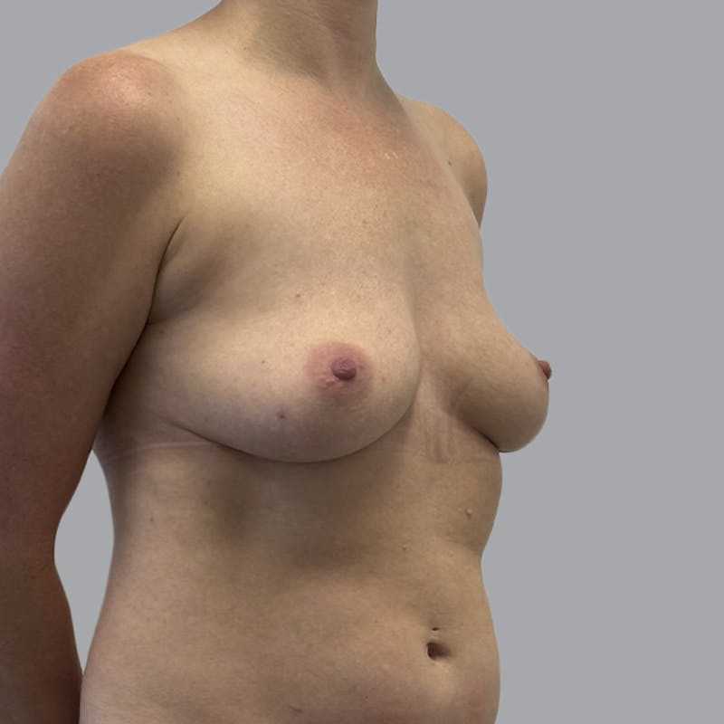 Breast Implant Removal Before & After Gallery - Patient 244451 - Image 4