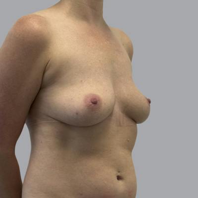 Breast Implant Removal Before & After Gallery - Patient 244451 - Image 4
