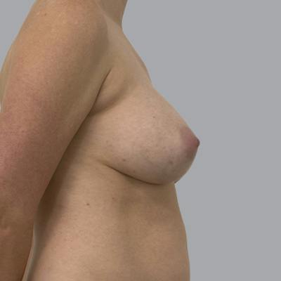 Breast Implant Removal Before & After Gallery - Patient 244451 - Image 5
