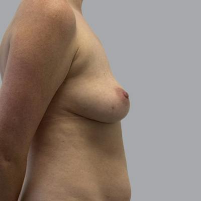 Breast Implant Removal Before & After Gallery - Patient 244451 - Image 6
