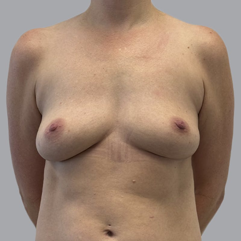 Breast Implant Removal Before & After Gallery - Patient 244451 - Image 2