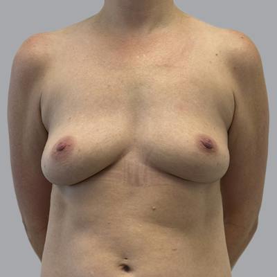Breast Implant Removal Before & After Gallery - Patient 244451 - Image 2