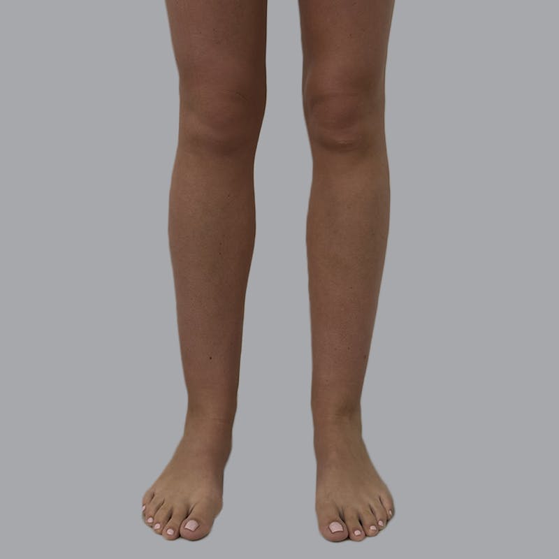 Lipedema Before & After Gallery - Patient 110280 - Image 1