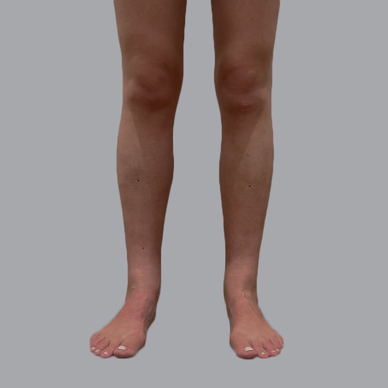 Lipedema Before & After Gallery - Patient 110280 - Image 2