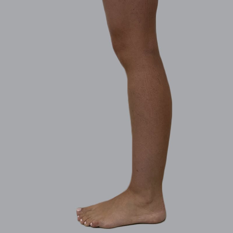 Lipedema Before & After Gallery - Patient 110280 - Image 5