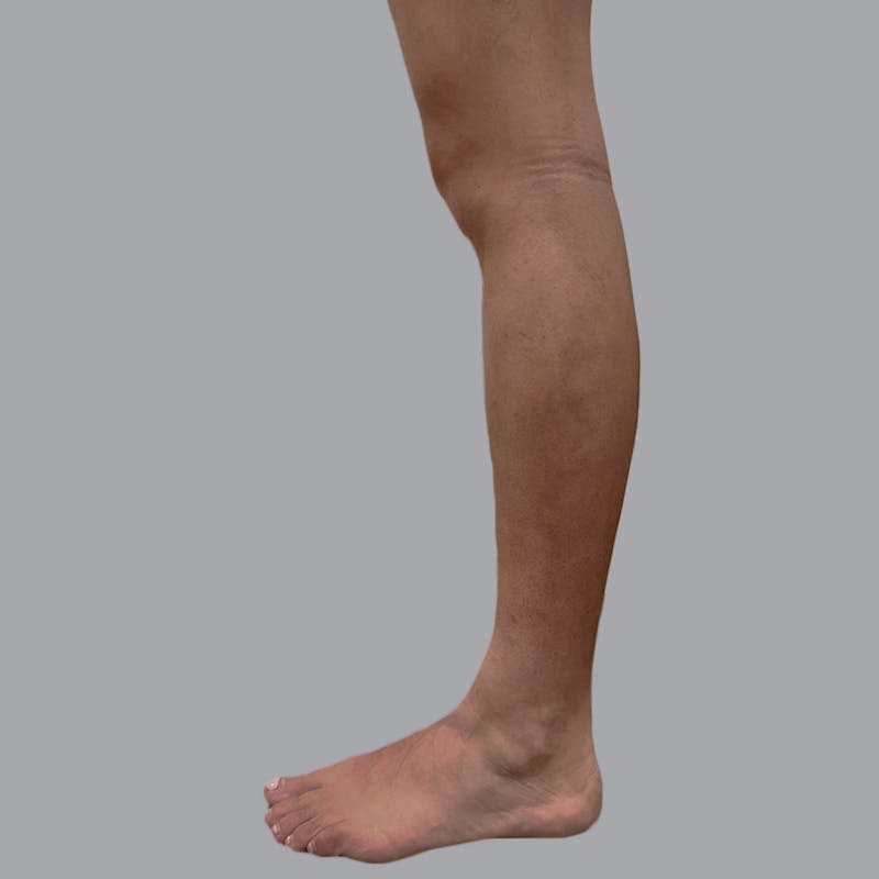 Lipedema Before & After Gallery - Patient 110280 - Image 6