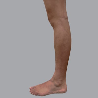 Lipedema Before & After Gallery - Patient 110280 - Image 6