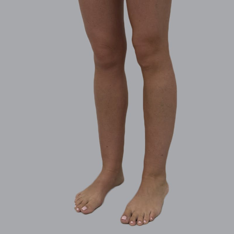 Lipedema Before & After Gallery - Patient 110280 - Image 3