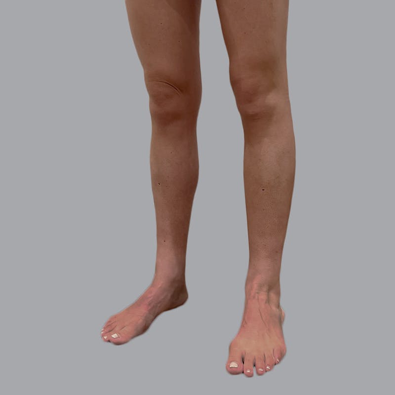 Lipedema Before & After Gallery - Patient 110280 - Image 4
