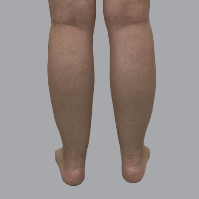 Lipedema Before & After Gallery - Patient 250672 - Image 3