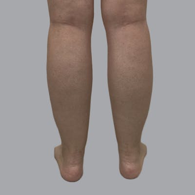 Lipedema Before & After Gallery - Patient 250672 - Image 3