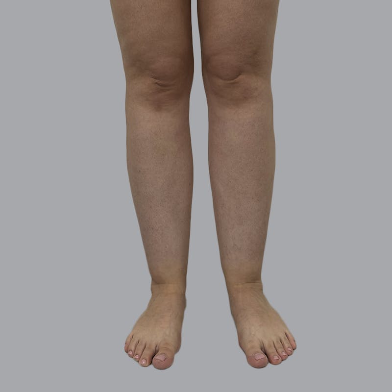 Lipedema Before & After Gallery - Patient 250672 - Image 1