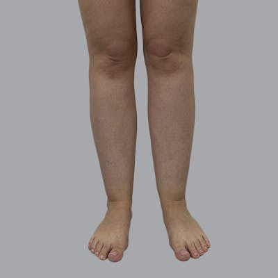 Lipedema Before & After Gallery - Patient 250672 - Image 1