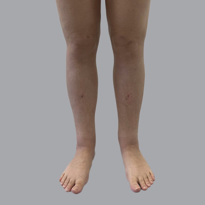 Lipedema Before & After Gallery - Patient 250672 - Image 2