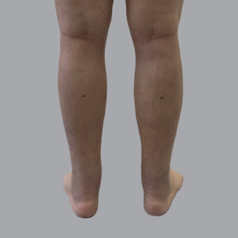 Lipedema Before & After Gallery - Patient 250672 - Image 4
