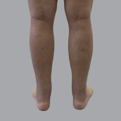 Lipedema Before & After Gallery - Patient 250672 - Image 4