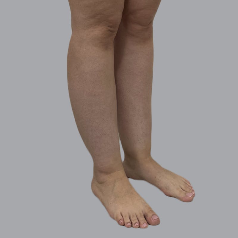 Lipedema Before & After Gallery - Patient 250672 - Image 5