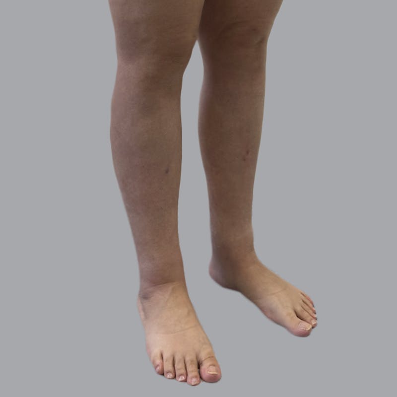 Lipedema Before & After Gallery - Patient 250672 - Image 6