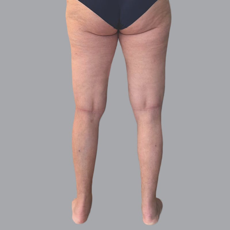 Lipedema Before & After Gallery - Patient 719903 - Image 4