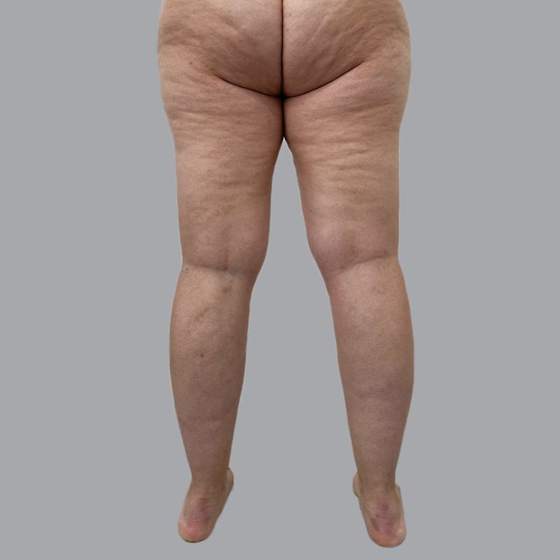 Lipedema Before & After Gallery - Patient 719903 - Image 3