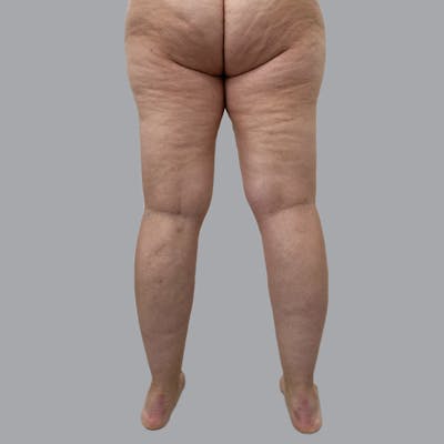 Lipedema Before & After Gallery - Patient 719903 - Image 3