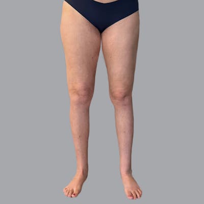 Lipedema Before & After Gallery - Patient 719903 - Image 2