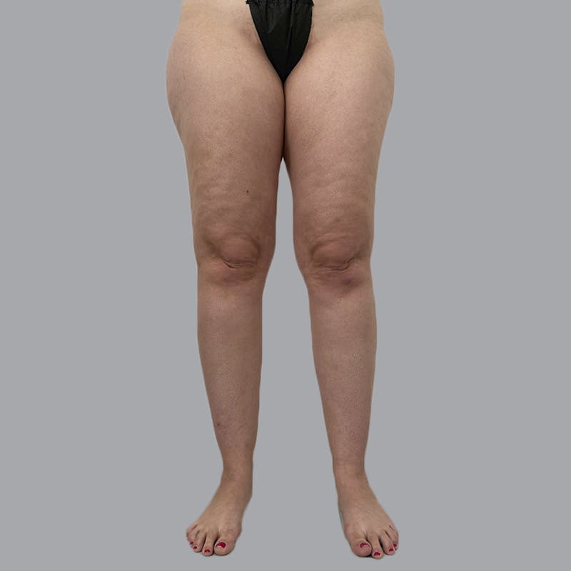 Lipedema Before & After Gallery - Patient 719903 - Image 1