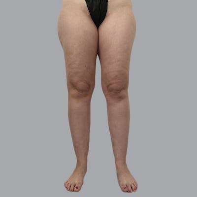 Lipedema Before & After Gallery - Patient 719903 - Image 1