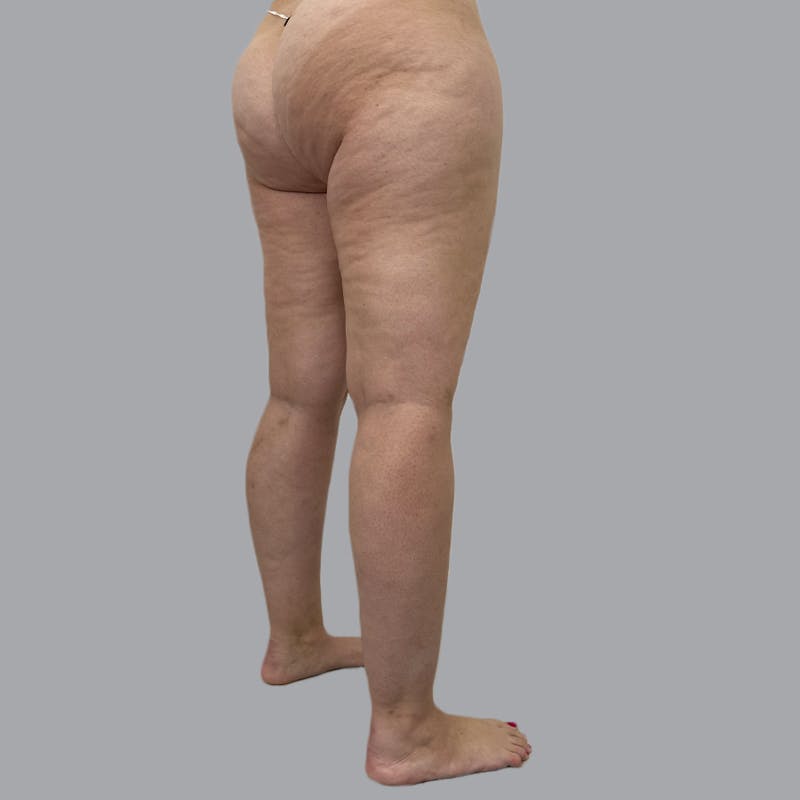 Lipedema Before & After Gallery - Patient 719903 - Image 5