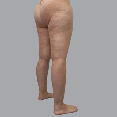 Lipedema Before & After Gallery - Patient 719903 - Image 5