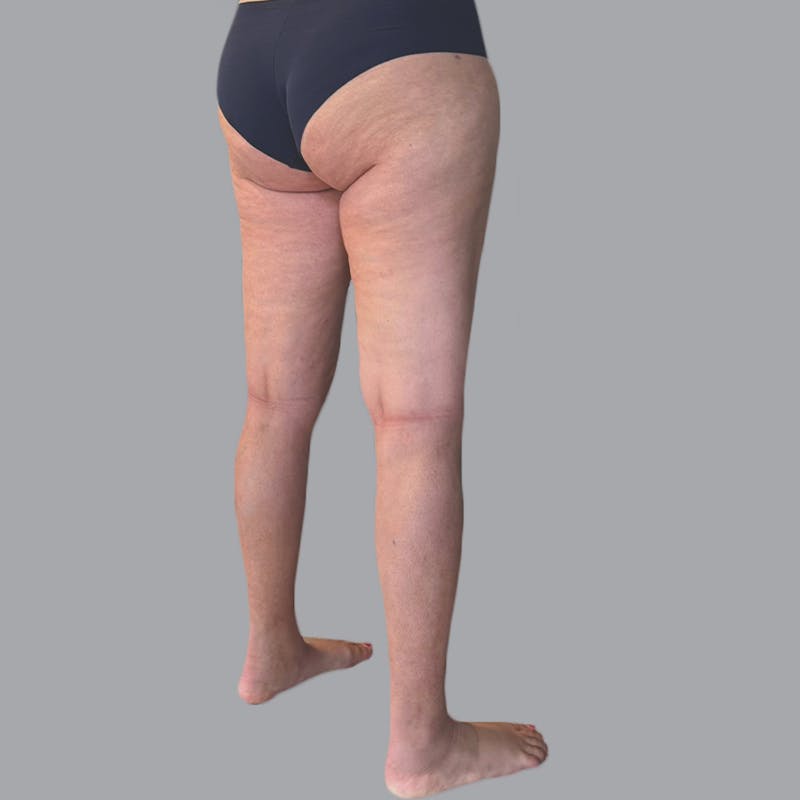 Lipedema Before & After Gallery - Patient 719903 - Image 6