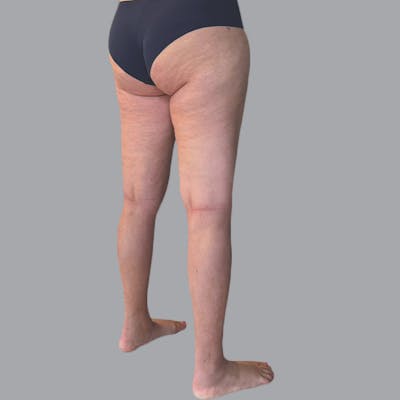 Lipedema Before & After Gallery - Patient 719903 - Image 6