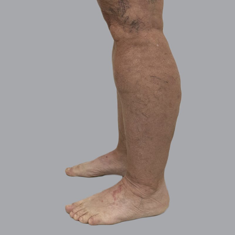 Leg Liposuction Before & After Gallery - Patient 756522 - Image 5