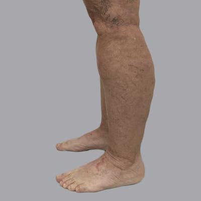 Lipedema Before & After Gallery - Patient 135752 - Image 5