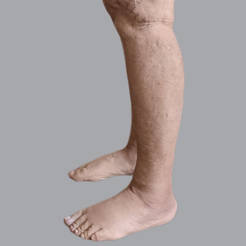 Leg Liposuction Before & After Gallery - Patient 756522 - Image 6