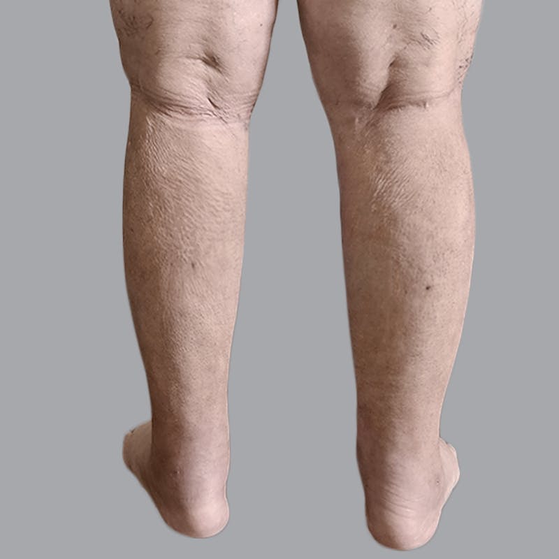 Leg Liposuction Before & After Gallery - Patient 756522 - Image 4