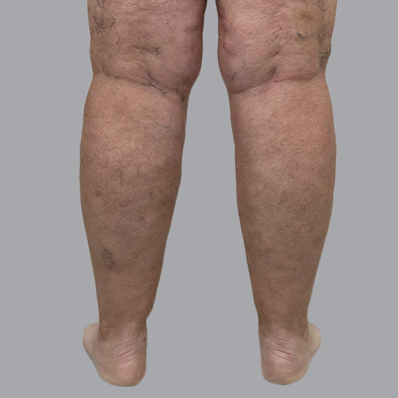 Leg Liposuction Before & After Gallery - Patient 756522 - Image 3