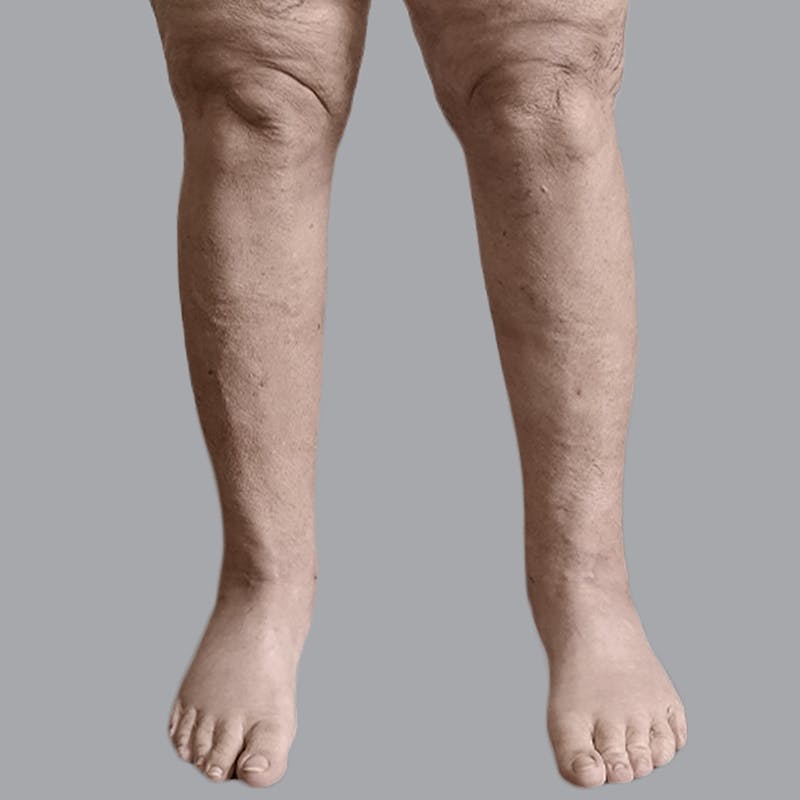 Leg Liposuction Before & After Gallery - Patient 756522 - Image 2