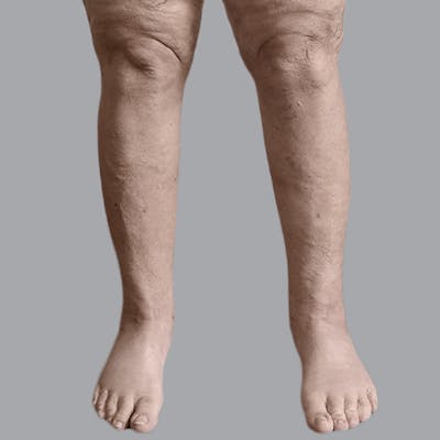 Lipedema Before & After Gallery - Patient 135752 - Image 2