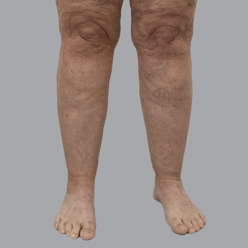 Leg Liposuction Before & After Gallery - Patient 756522 - Image 1